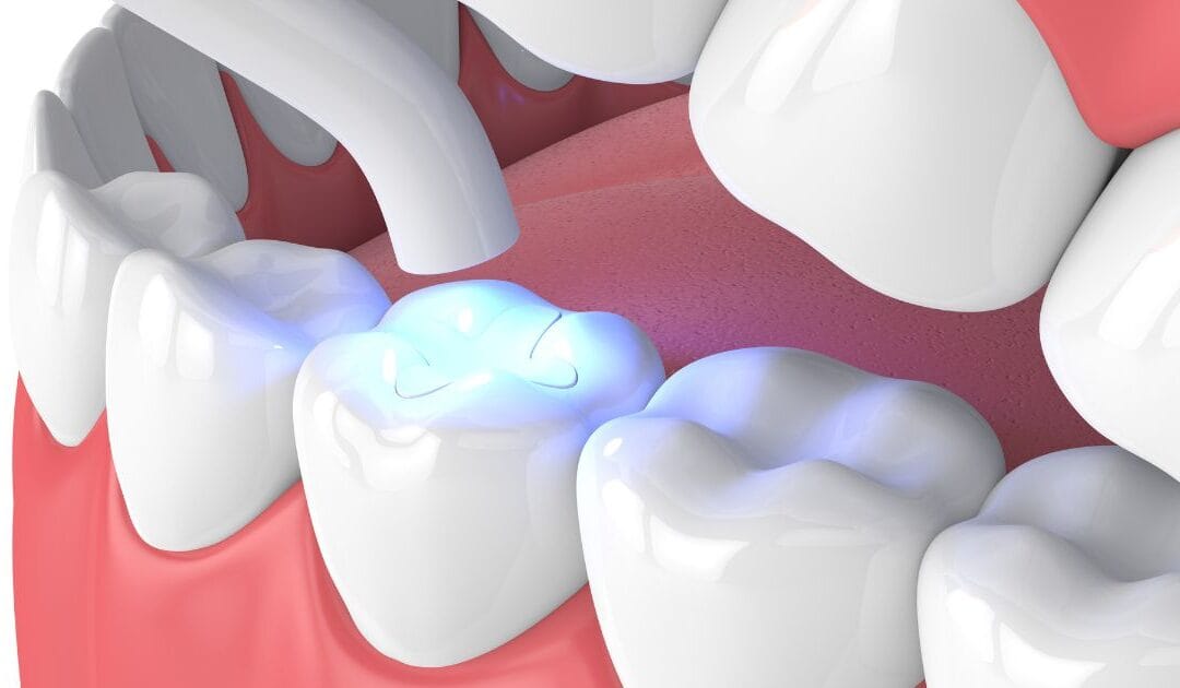 Tecken på att du kan behöva en tandfyllning
